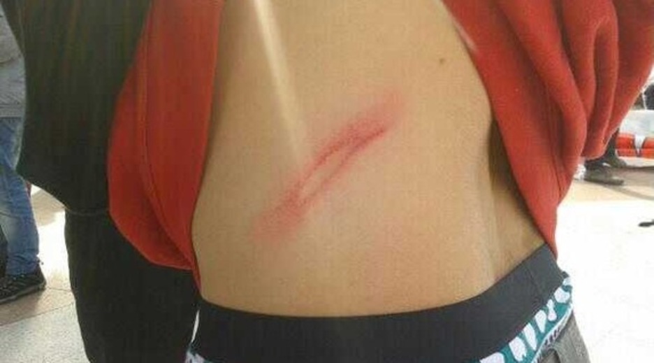 Gazte bati zauriak eragin dizkio Ertzaintzak. (NAIZ.INFO)