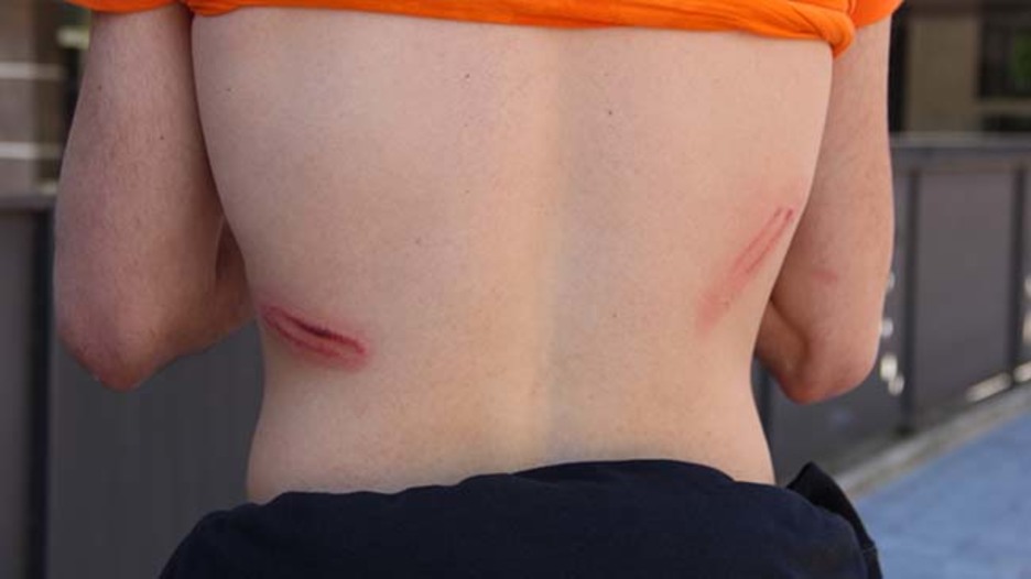 Ertzaintzak emandako kolpeen markak. (TOPATU.INFO)