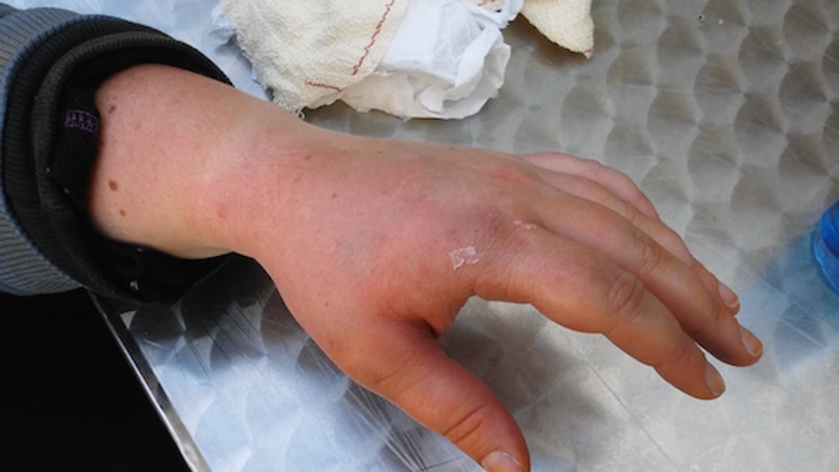 Gasteizko herri harresian kolpatutako gazteak. ©HumanWall International 