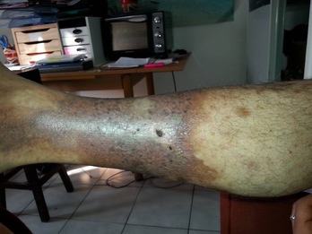 Los policías pisaron la pierna ulcerada de Manu Azkarate durante su detención. (@GuillermoMarto1)
