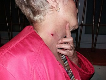 Impacto de balín en el cuello de una persona. (naciodigital.cat)