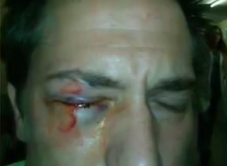 El joven de Atarrabia perdió la visibilidad de un ojo al recibir un pelotazo durante la huelga de setiembre de 2012. (Ateak Ireki)