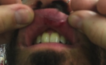 Imagen de las secuelas del puñetazo que ha recibido una de las personas que se encontraban en el momento de la identificación.