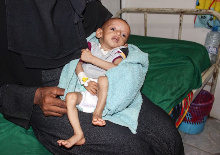 Un menor yemení con signos de malnutrición. (AFP)