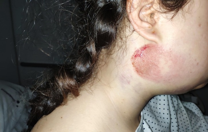 Huellas de la agresión en el rostro de Anne, cuando estaba hospitalizada. (NAIZ)