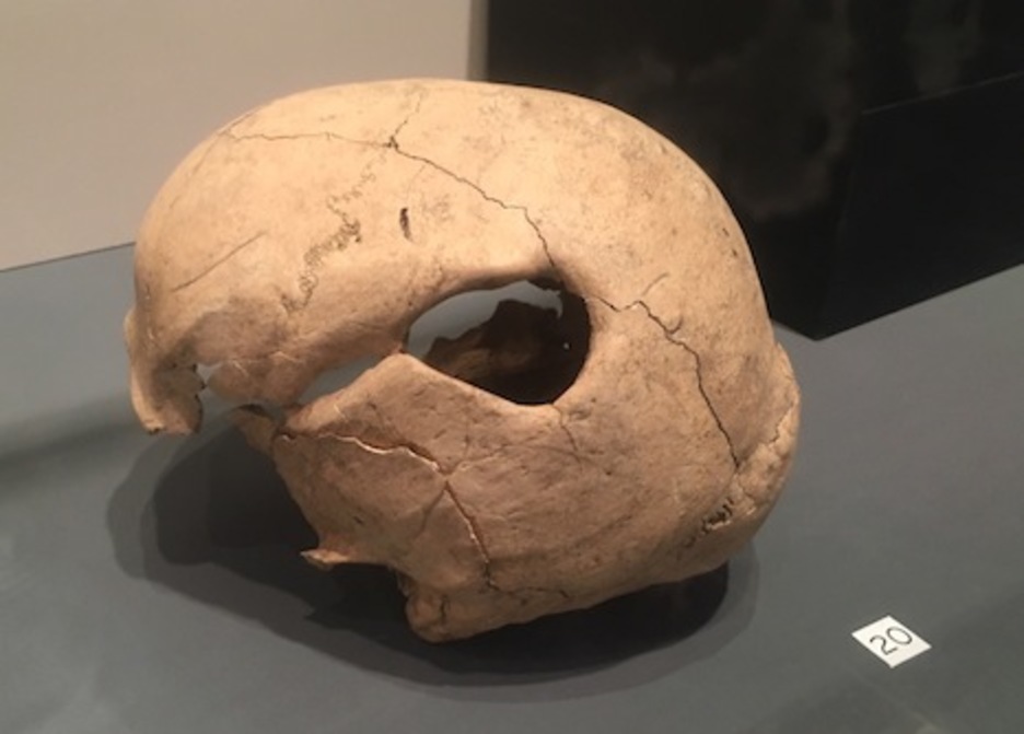 Impresionante boquete de un varón que consiguió sobrevivir a una lesión por arma blanca que habría sufrido entre los siglos XI y XIII.