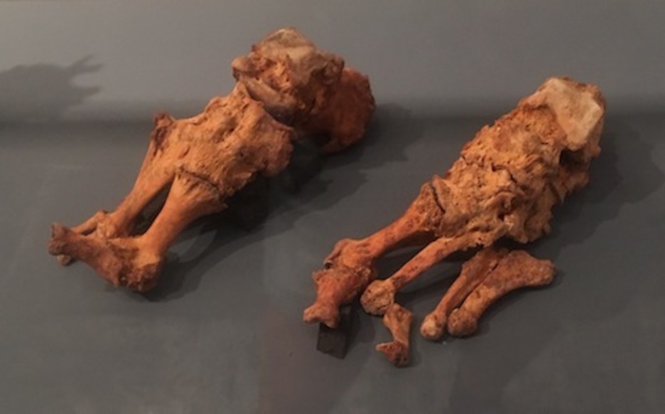 Pie con artrotopatía degenerativa de un hombre del siglo XIX que fue enterrado en la catedral de Iruñea.