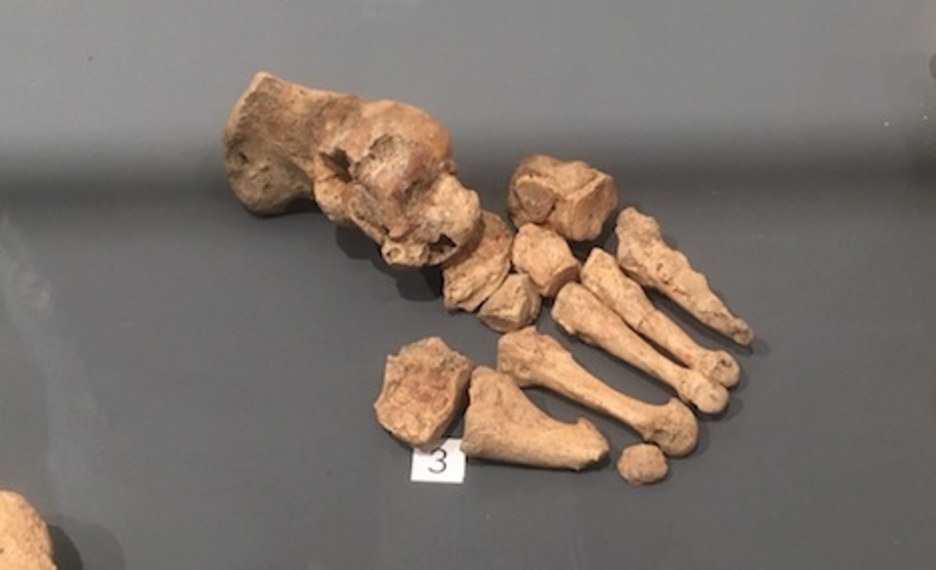 Pie de un hombre de época romana enterrado en la plaza del Castilla que había sufrido lepra.