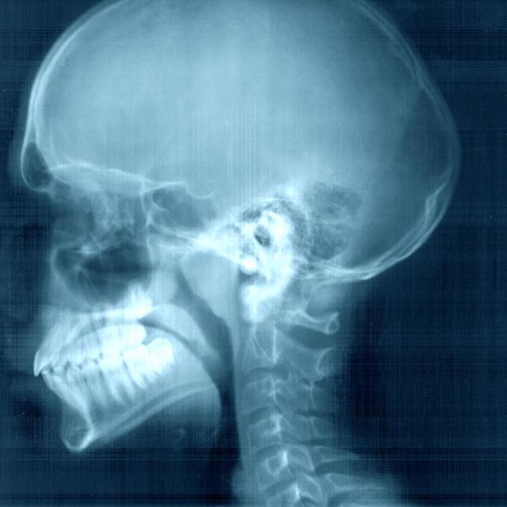 Radiografía de una cabeza utilizando los rayos X. (NAIZ)