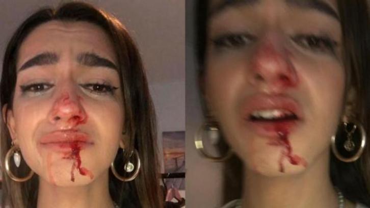 La joven ha compartido en redes sociales su imagen tras la agresión tránsfoba sufrida.