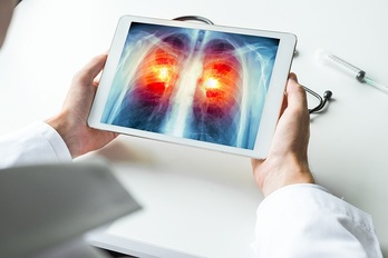 Nuevo avance en el tratamiento del cáncer de pulmón. (US)