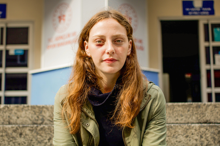 Misra Sapan muestra el hematoma que le causó el rodillazo que le propinó en el ojo un policía. (Albert NAYA MERCADAL)