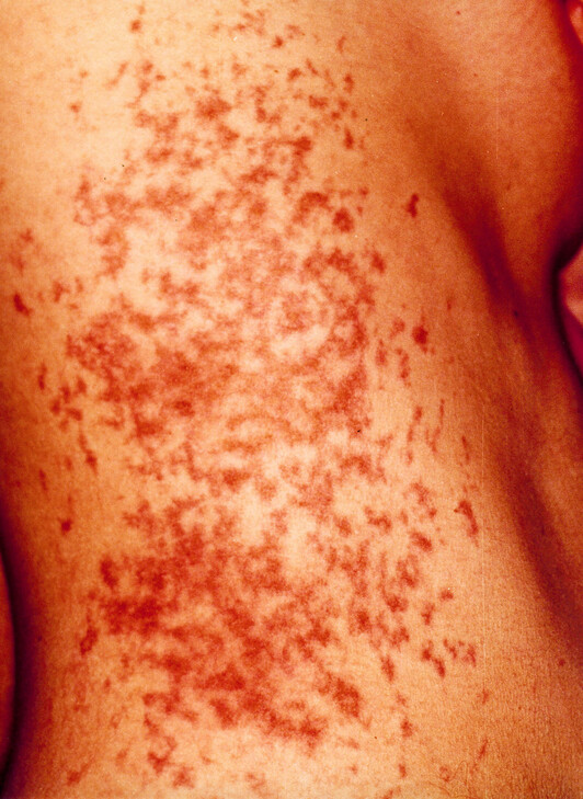 Iratxe Sorzabalen gorputzean marka hauek utzi zituen komisaldegitik pasa izanak.