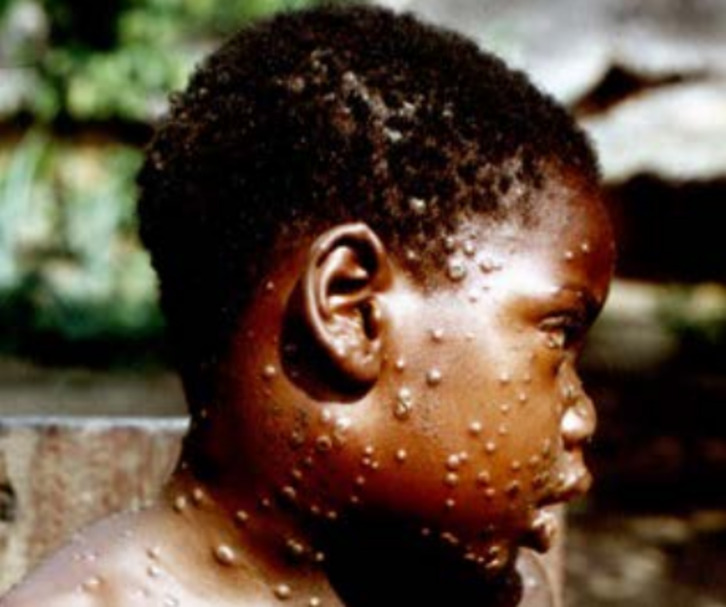 Efectos de la viruela del mono, una enfermedad endémica en África.