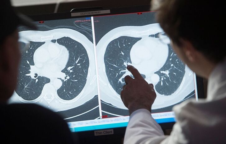 Científicos observan tomografías de un paciente con y sin tumores.