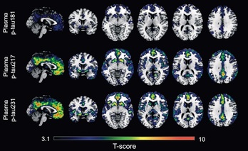 Un estudio ha identificado dos biomarcadores en sangre que permiten captar los primeros indicios del Alzheimer.