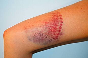 Imagen en la que se aprecia las secuelas de la agresión sufrida por la joven.