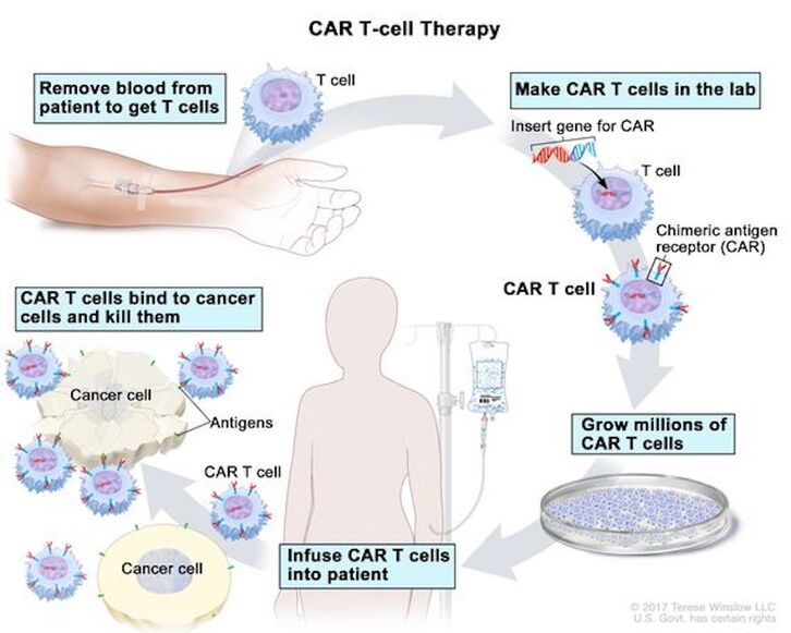 CAR-T minbiziaren aurkako terapia berritzailea.