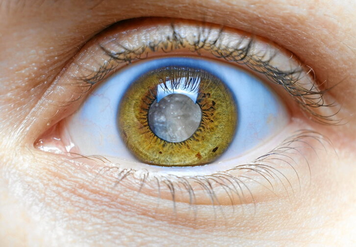 Glaukoma nerbio optikoei eragiten dien gaixotasuna da, itsutasunaren bigarren kausa munduan.