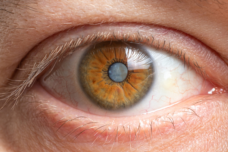 Glaukoma nerbio optikoei eragiten dien gaixotasuna da, itsutasunaren bigarren kausa munduan.