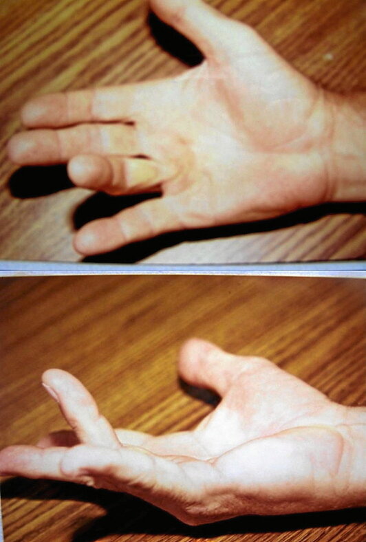 Dupuytrenen gaixotasunak jotako eskua.