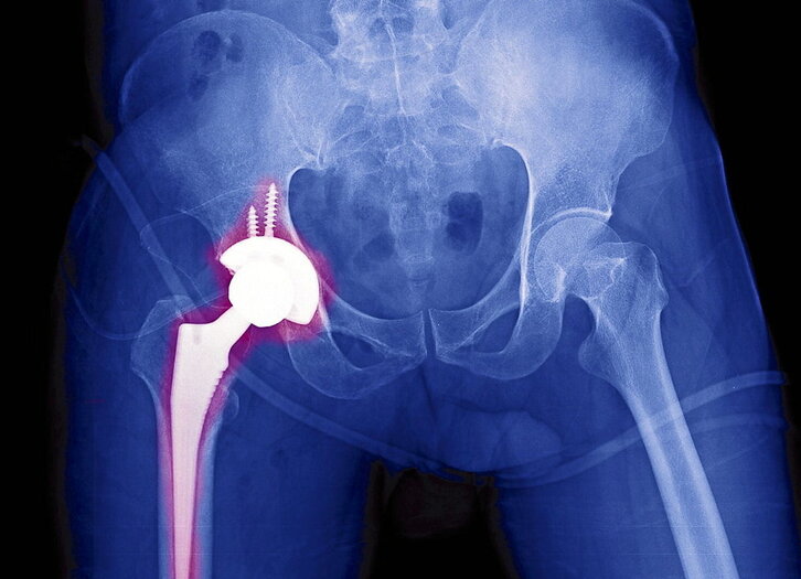 Oro har, aldaka zein belaunen protesien aurrerapen handia igarri da.