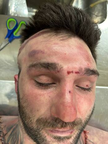 Marcas en la cabeza del cadáver de Eneko Valdés.