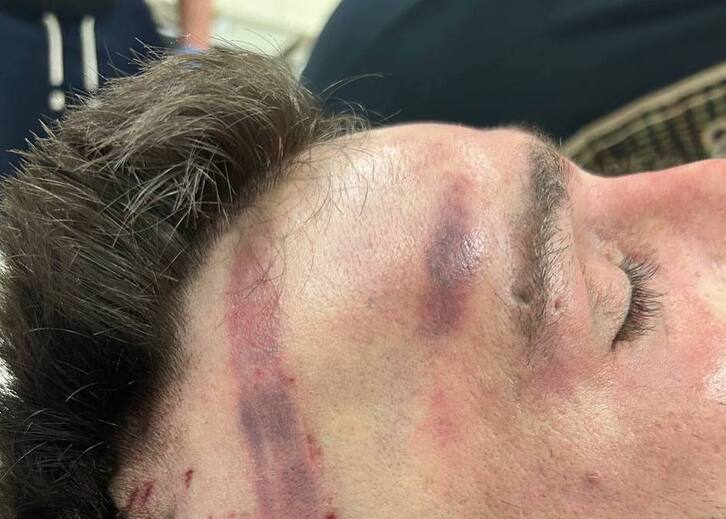 Marcas compatibles con porrazos en la cabeza del fallecido.