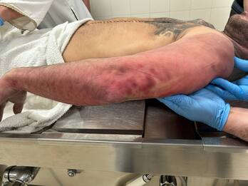 Marcas en el cuerpo de Eneko Valdés.