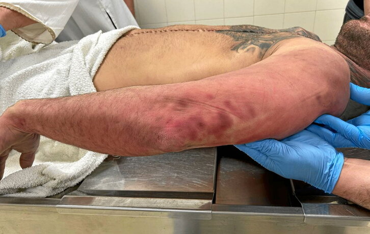 Marcas en el cuerpo de Eneko Valdés.