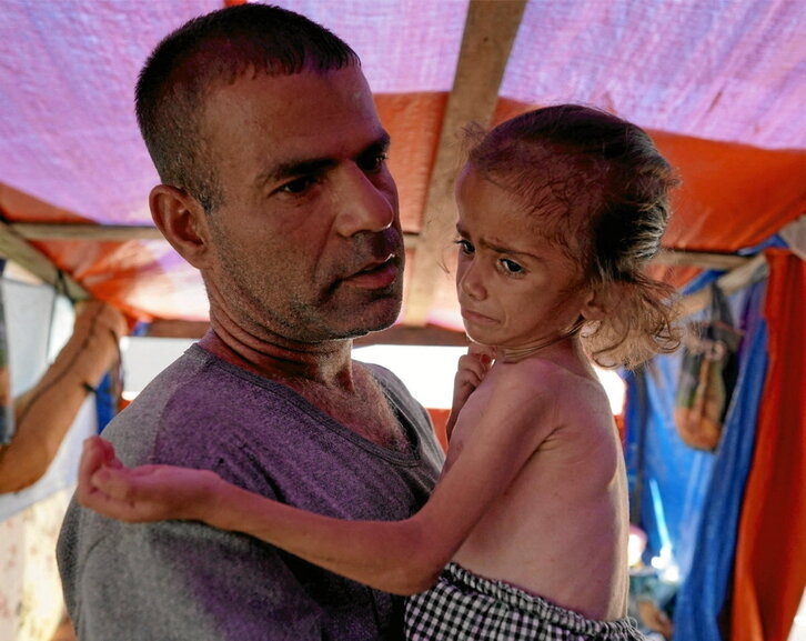 Hana Abdelrahaman al-Rai, niña palestina de cuatro años con señales de malnutrición.