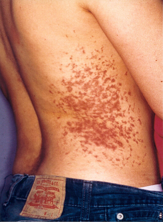 Marcas en el cuerpo de Iratxe Sorzabal tras su detención por la Guardia Civil.