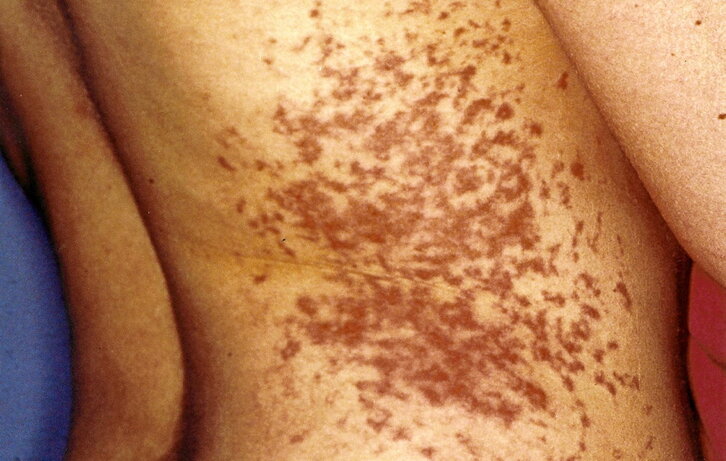 Marcas en el cuerpo de Iratxe Sorzabal tras su detención por la Guardia Civil.