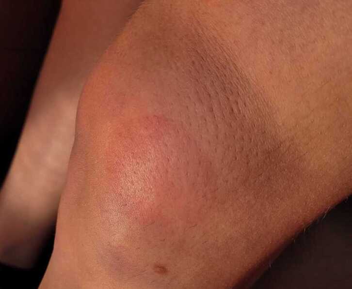 Rodilla herida de uno de los vecinos de Berriozar como consecuencia del disparo de una bala de foam por la Policía Foral.