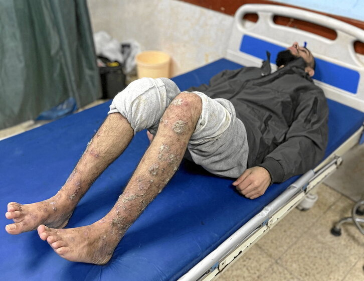 Los presos palestinos presentaban enfermedades cutáneas, amputaciones y lesiones.