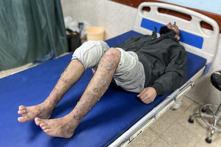 Los presos palestinos presentaban enfermedades cutáneas, amputaciones y lesiones.