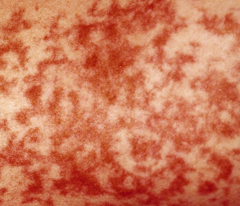 Heridas en la piel de Iratxe Sorzabal, tras esta detención en 2001.