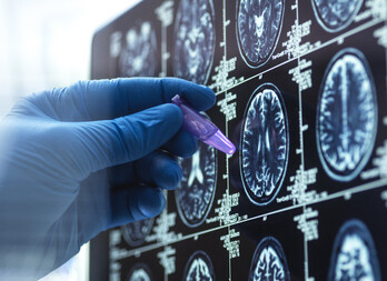 Un científico prepara una muestra en un ensayo sobre la demencia y el alzheimer.