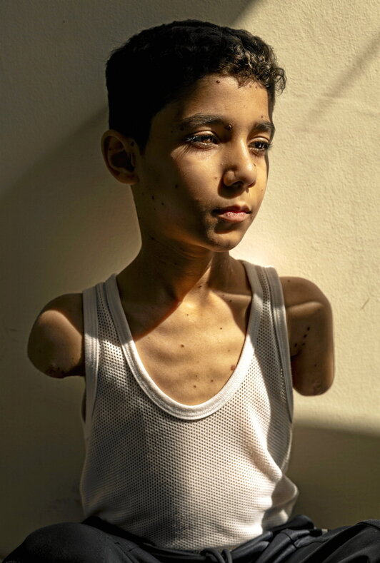 En la fotografía que abre esta información, el retrato ganador: Mahmoud Ajjour, 9 años y la tragedia de una infancia destrozada por Israel.