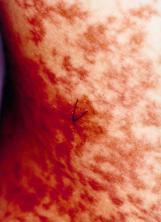 Marcas que dejaron los electrodos en el cuerpo de Iratxe Sorzabal.