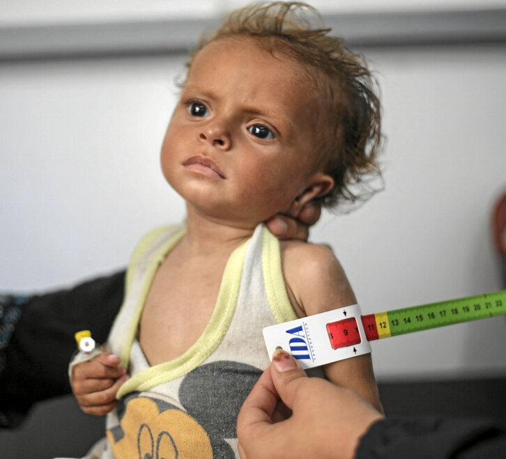 La medida del brazo de un niño palestino evidencia un caso grave de malnutrición.