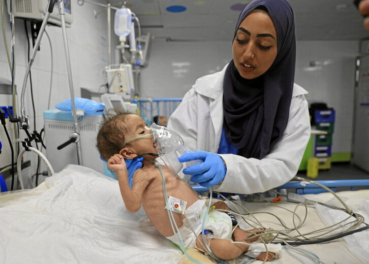 Desnutrizioak jotako ume bat, Khan Yuniseko Nasser ospitalean.