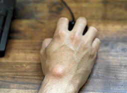 Pertsona askori eskumuturrean sortzen zaizkien koskorrak ganglioiak dira.