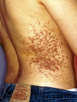 Marcas de electrodos en el cuerpo de Sorzabal tras su detención en 2001.