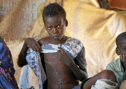 Ibrahim Ismail muestra sus cicatrices por un ataque en El Fasher.