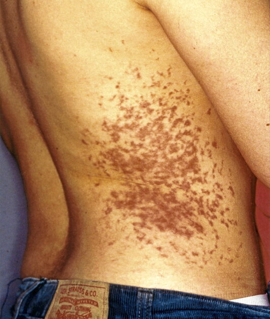 Fotografía de las marcas de los electrodos solicitadas por los médicos forenses de la Audiencia Nacional.