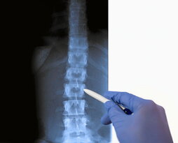 Populazio orokorraren %6k du espondilolisia, baina gehienetan oharkabean pasatzen da.