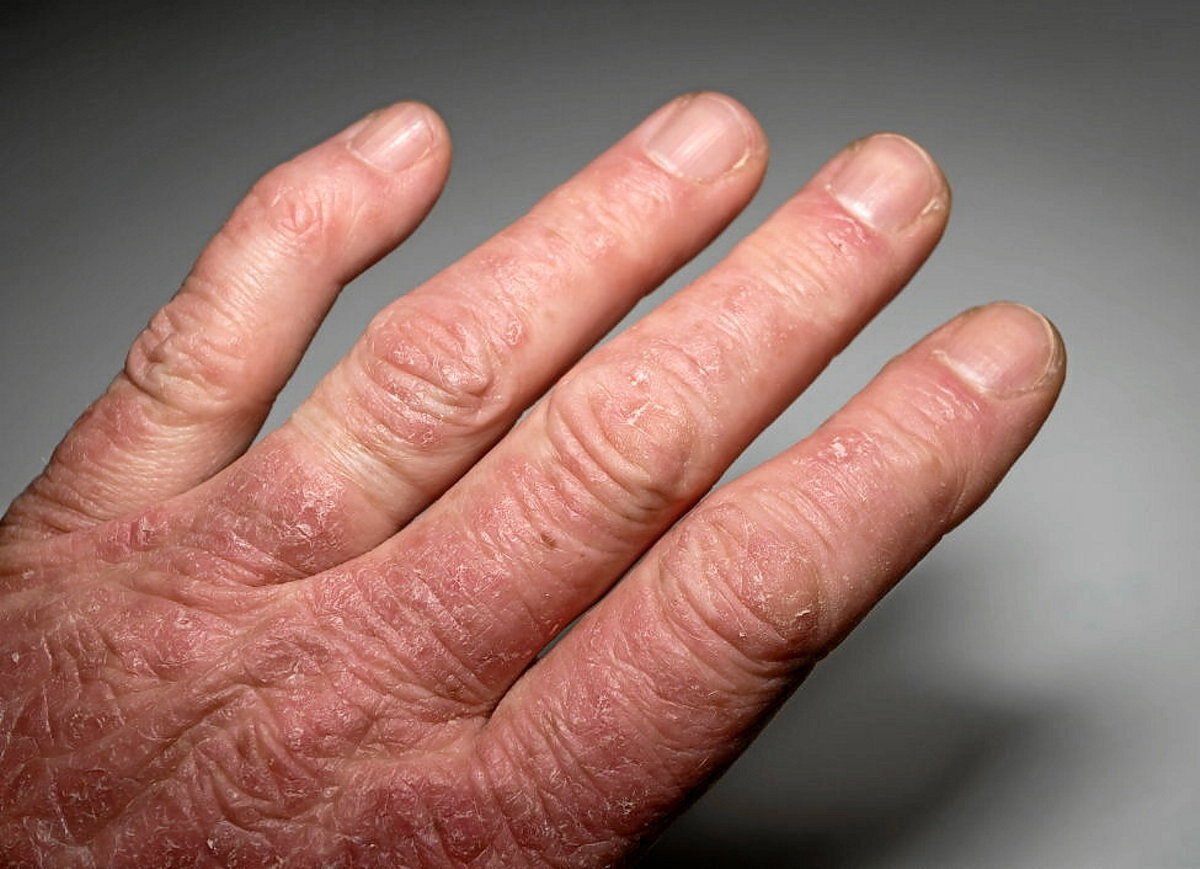 Artritis psoriasikoa | Iritzia | GAUR8