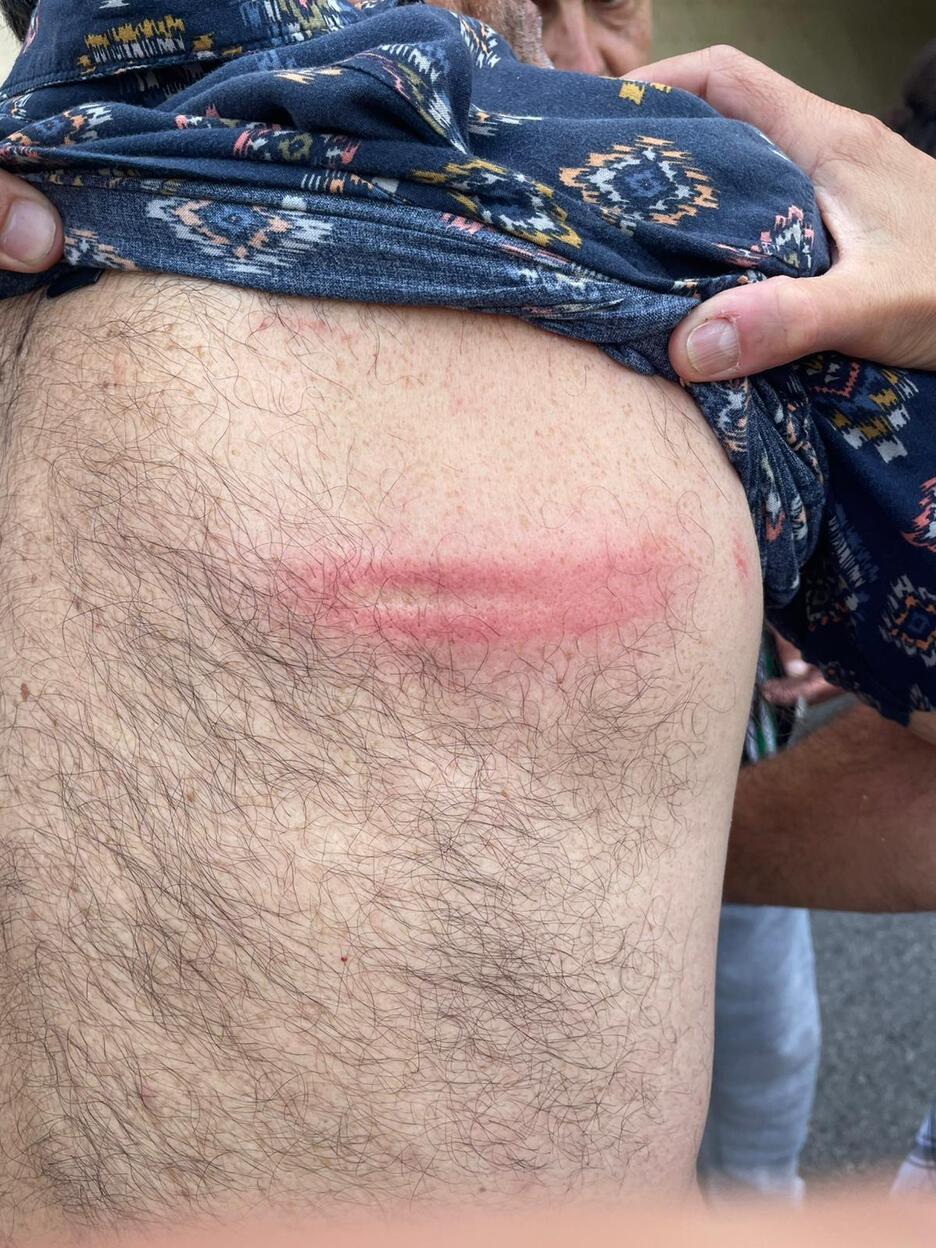 Marca de un porrazo en la espalda de una persona que había acudido al aeropuerto. 