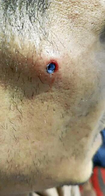 Imagen del balín que impactó en el rostro.